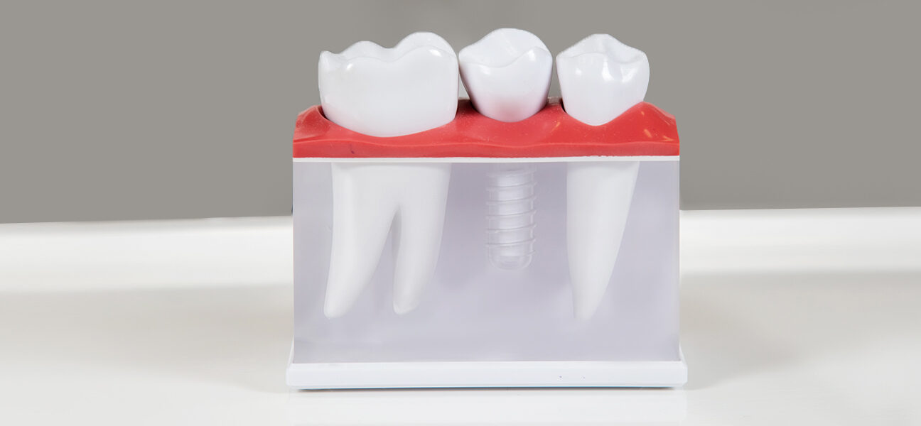 How Long Does the Dental Implant Process Take?