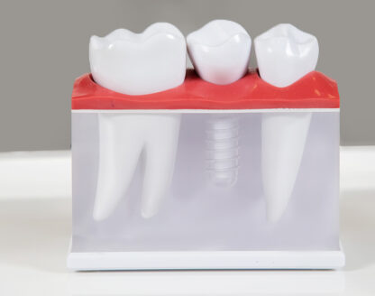 How Long Does the Dental Implant Process Take? 