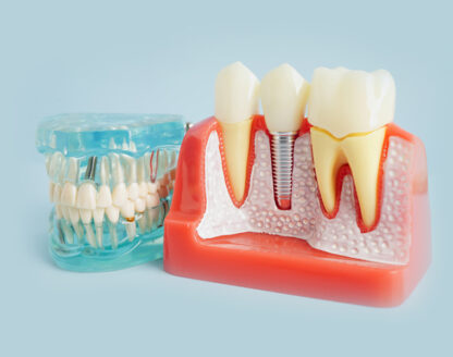 Implants vs Dentures for a More Confident Smile 