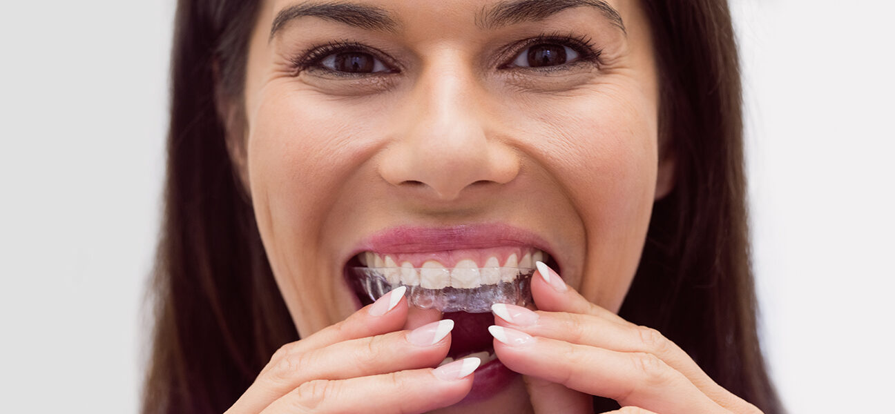 Why Everyone Prefers Invisalign Over Traditional Braces?