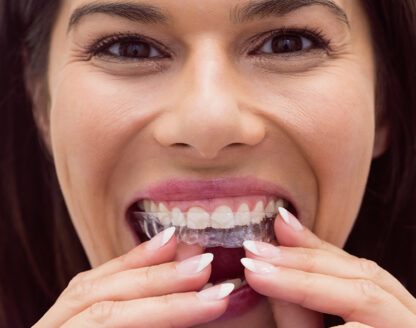 Why Everyone Prefers Invisalign Over Traditional Braces? 