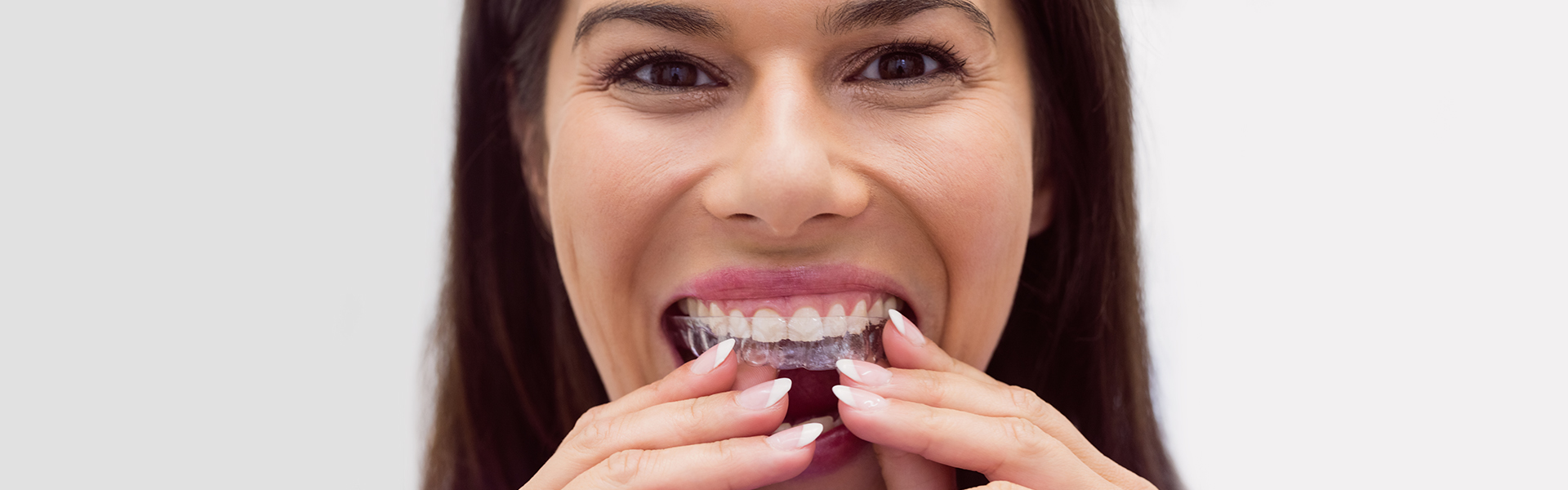 Why Everyone Prefers Invisalign Over Traditional Braces?