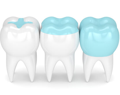 Same-Day Dental Crowns: Convenience and Efficiency in Dentistry 