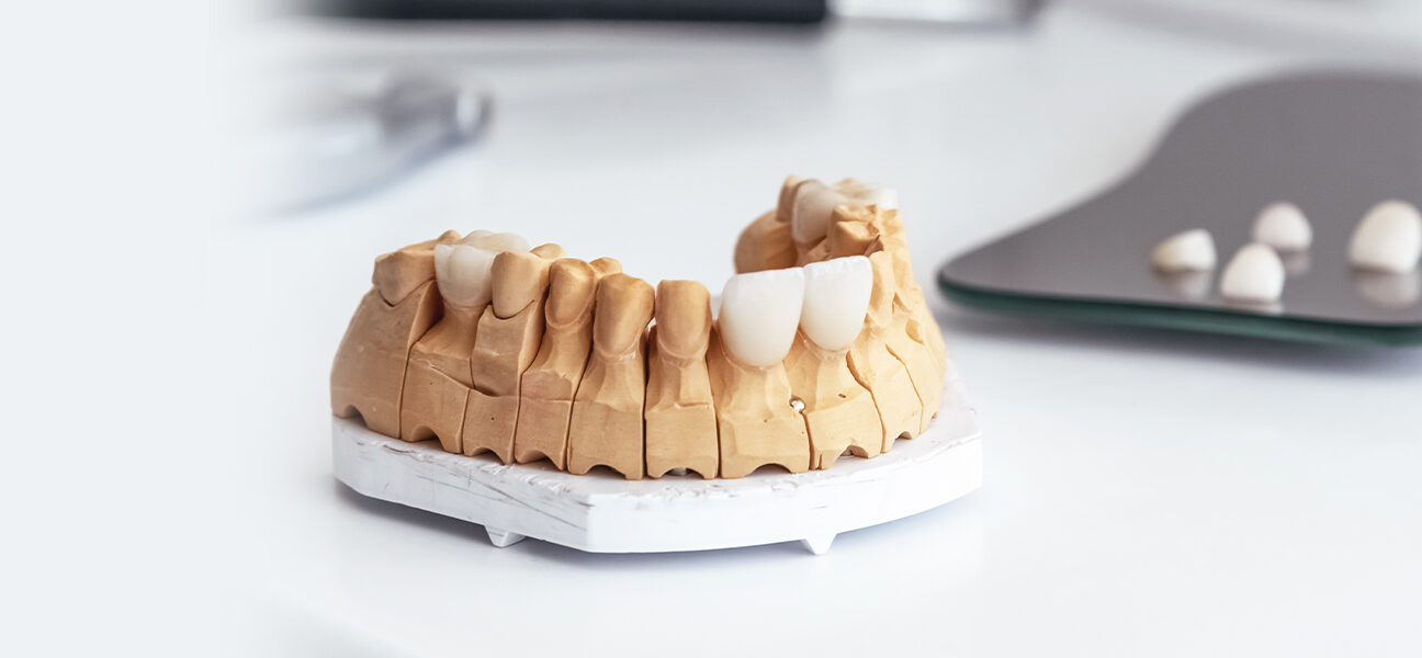 What Are the Latest Advancements in Dental Crown Materials?