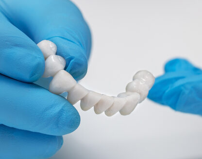 What Happens If a Dental Bridge Fails? Solutions for Repair and Replacement 