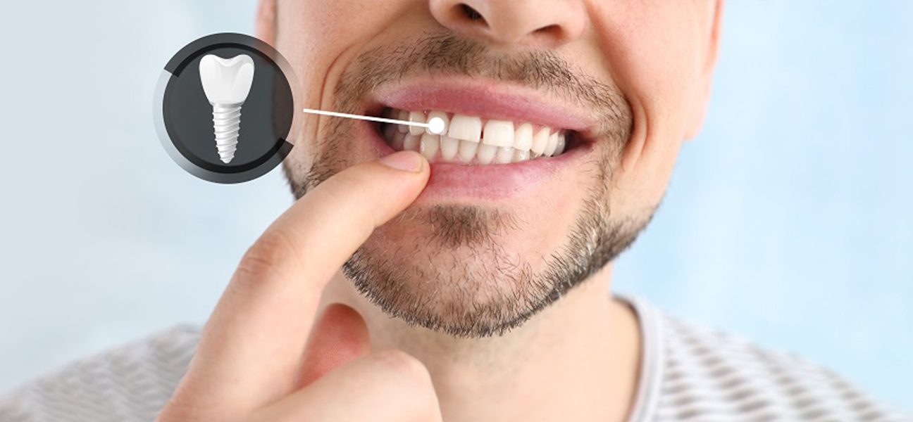 How Long Do Dental Implants Last? What Lincoln Patients Should Know