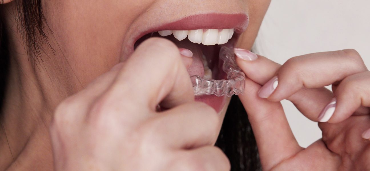 How Invisalign Works for Teens vs. Adults
