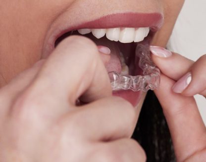 How Invisalign Works for Teens vs. Adults 