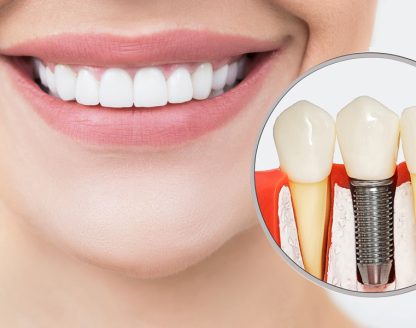 dental implants in Lincoln 