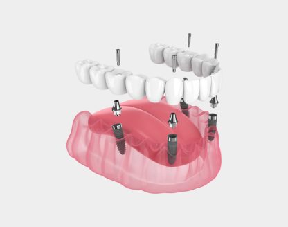 dentist in Lincoln 