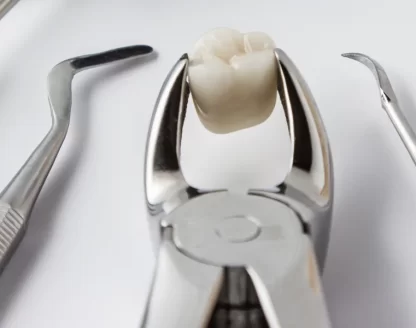 How-Long-Does-It-Take-to-Recover-from-a-Tooth-Extraction 